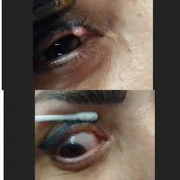 خالبرداری در یک جلسه تهرانسر