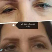 کلیه خدمات پلاسما پلکسر