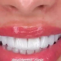 کامپوزیت دندان روکش دندانپزشک تهرانسر اکباتان پونک