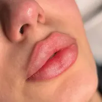 آموزش ژل و بوتاکس