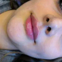 فیلر بوتاکس