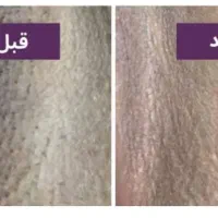 سفیدکردن‌نواحی تیره بدن|خدمات آرایشگری و زیبایی|ارومیه, |دیوار