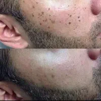 لیزر خال های سیاه و گوشتی. اقایان