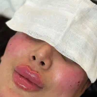 جشنواره ویژه ژل و بوتاکس