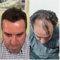 کاشت مو/کاشت ریش/کاشت ابرو اقساط*ی در اصفهان