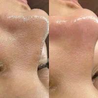 فیشال وپاکسازی پوست واپیلاسیون بدن