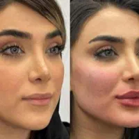 ژل بوتاکس فیلر چشم زاویه فک گونه چانه فشیال بیکینی|خدمات آرایشگری و زیبایی|قم, زنبیل آباد|دیوار