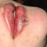 اف ویژه ژل و بوتاکس