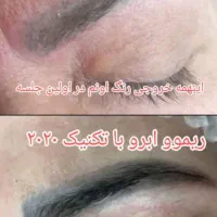 ریموو تخصصی ابرو