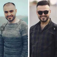 کاشت مو فول تراکم (فقط با ۲۰میلیون)