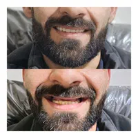 دندانسازی(بلوارهدایت)دندان مصنوعی/دندان سازی|خدمات آرایشگری و زیبایی|مشهد, هدایت|دیوار