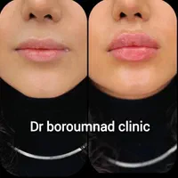 فیلر/ ژل لب تخصصی ۱.۳۰۰ ، بوتاکس پیشانی / لیفت۷۶۰