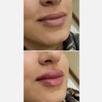 جشنواره خدمات زیبایی، فیلر بوتاکس جراحی های سرپایی