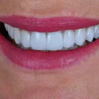 کامپوزیت ونیر و بلیچینگ (سفید کردن) دندان|خدمات آرایشگری و زیبایی|تاکستان, |دیوار