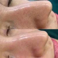 تخفیف ویژه پاکسازی پوست