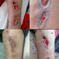 کلینیک تخصصی درمان انواع زخم(بستر و دیابت) فردوس|خدمات آرایشگری و زیبایی|اصفهان, محله سفلی|دیوار