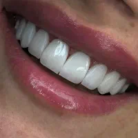 جشنواره کامپوزیت دندان|خدمات آرایشگری و زیبایی|کرج, کوی کارمندان شمالی|دیوار