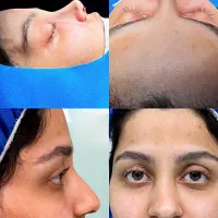 عمل جراحی بینی وپیکرتراشی،جشنواره تابستان تخفیف۳۰٪|خدمات آرایشگری و زیبایی|تهران, آرژانتین|دیوار