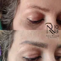 پاک کردن تتو با لیزر/ریموو ابرو/کربن تراپی(پزشک)