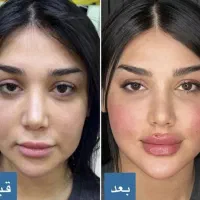 جشنواره ۴ روزه تزریق فیلر و بوتاکس و ژل