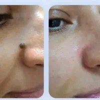 خالبرداری حرفه ای بدون درد و خونریزی