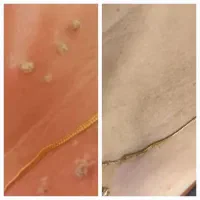 حذف کک و مک ،خال ،منگوله گوشتی بدون برگشت گیاهی|آرایشی، بهداشتی، درمانی|زنجان, |دیوار
