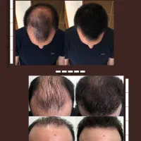 موهات کم پشت شده  علتش رو پیدا کن