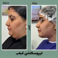 جشنواره ی لیپوساکشن غبغب و بوکال فت توسط پزشک