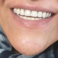 دندانسازی/پروتز متحرک/دندان مصنوعی/دست دندان