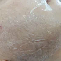 الکترولیز موهای زائد