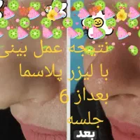 لیزرمیکرو پلاسمالیفت زیبایی/ بینی شیک/بلفاروپلاستی|خدمات آرایشگری و زیبایی|کرمانشاه, |دیوار