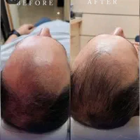 تزریقات، فیلر بوتاکس جوانسازی و جراحی‌های تخصصی|خدمات آرایشگری و زیبایی|اهر, |دیوار