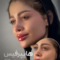 تزریق فیلر لب روسی|آرایشگاه و سالنهای زیبایی|تهران, صادقیه|دیوار