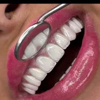 کامپوزیت دندان در تهران/طراحی لبخند|خدمات زیبایی و سلامت|تهران, کاشانک|دیوار