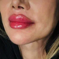 تخفیف بوتاکس و ژل|خدمات آرایشگری و زیبایی|دهگلان, |دیوار