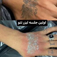 دستگاه پیکوشور با نتایج ماندگار