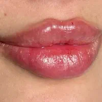 تزریق ژل لب(صورت)بوتاکس سیار
