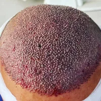 کاشت مو و ابرو