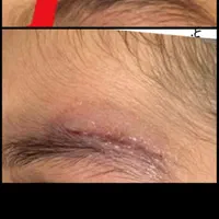 چسپ مایع ترمیم کننده ی زخم exofin آمریکایی وارداتی|خدمات آرایشگری و زیبایی|رفسنجان, |دیوار