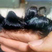 پروتز مو کاشت مو تعویض چسب ترمیم مو ریموور زیر کار