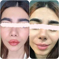 انجام بوتاکس فیلر ژل مزو    اقساط بدون پیش پرداخت|خدمات آرایشگری و زیبایی|کرمان, |دیوار