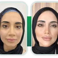 ژل و بوتاکس|خدمات آرایشگری و زیبایی|جیرفت, |دیوار