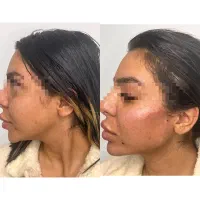 تزریق ژل و بوتاکس و مادلینگ عربی|خدمات آرایشگری و زیبایی|کرمانشاه, |دیوار