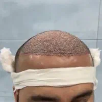 کاشت مو با جدید ترین تکنیک|خدمات آرایشگری و زیبایی|دزفول, |دیوار