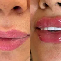 تزریق فیلر و بوتاکس