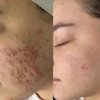 پوست،فیشال،مزوژل و لیزر مو