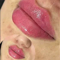 فیلر و بوتاکس