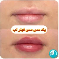 تخفیفات ۵۵٪ دکتر ملائی ،مزو بوتاکس فیلر ژل لب روسی|خدمات آرایشگری و زیبایی|مشهد, سرافرازان|دیوار