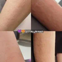 لیزر کندلا اصلی برای موهای زائد در مطب روشا|خدمات آرایشگری و زیبایی|کوهدشت, |دیوار