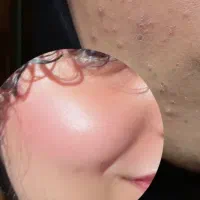 کرم بیوممتیک  آنتی آکنه  ضد جوش